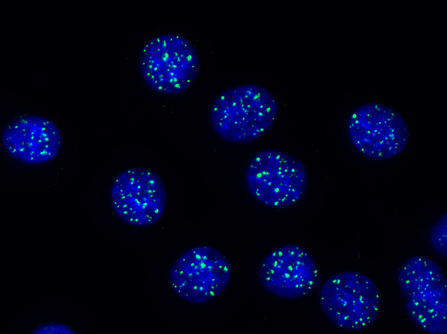 Cellule tumorali irradiate viste con un microscopio a fluorescenza. In blu il Dna, in verde la proteina che ripara il Dna, accumulata nelle lesioni.