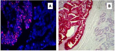 Figura 1: Amplificazione del gene EGFR